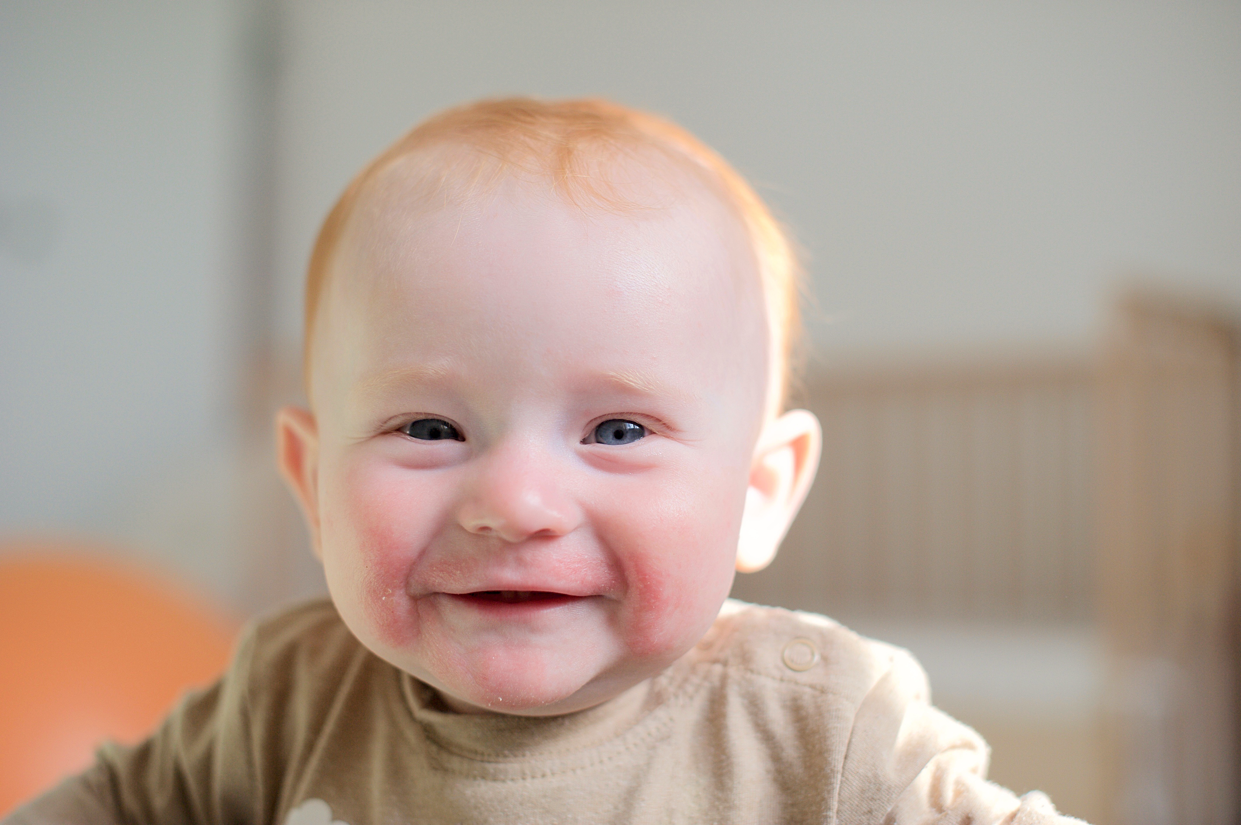 Beautiful redhead baby with atopic dermatitis smiling